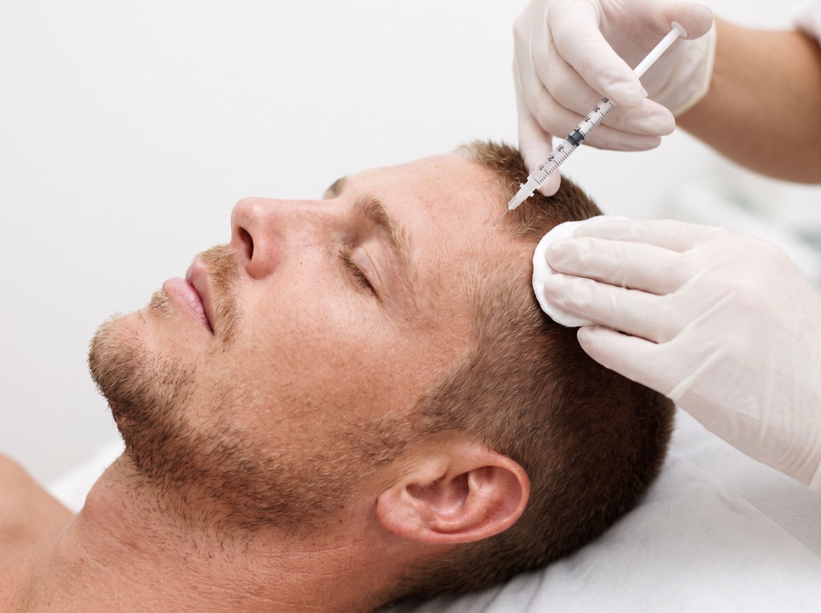 Mesoterapia capilar
